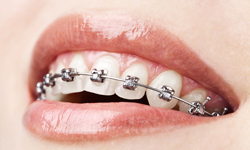 Brackets de autoligado